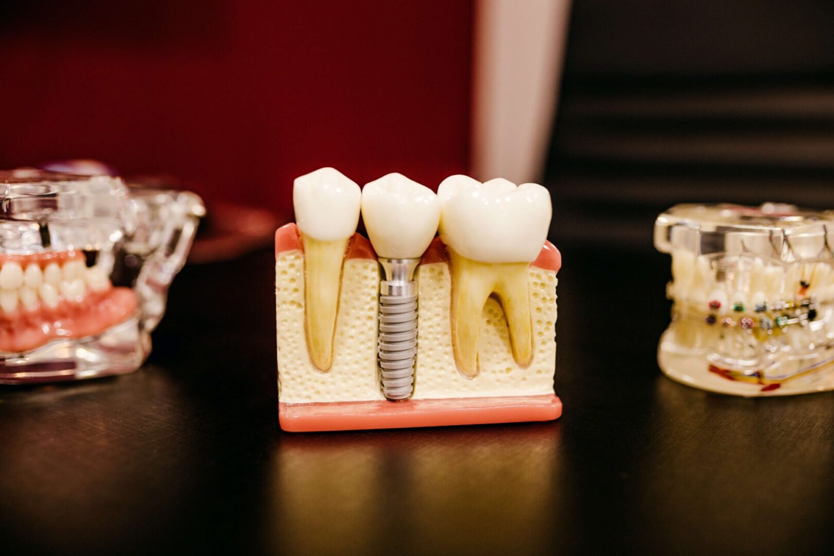 A tooth implant is placed in the middle of three teeth.