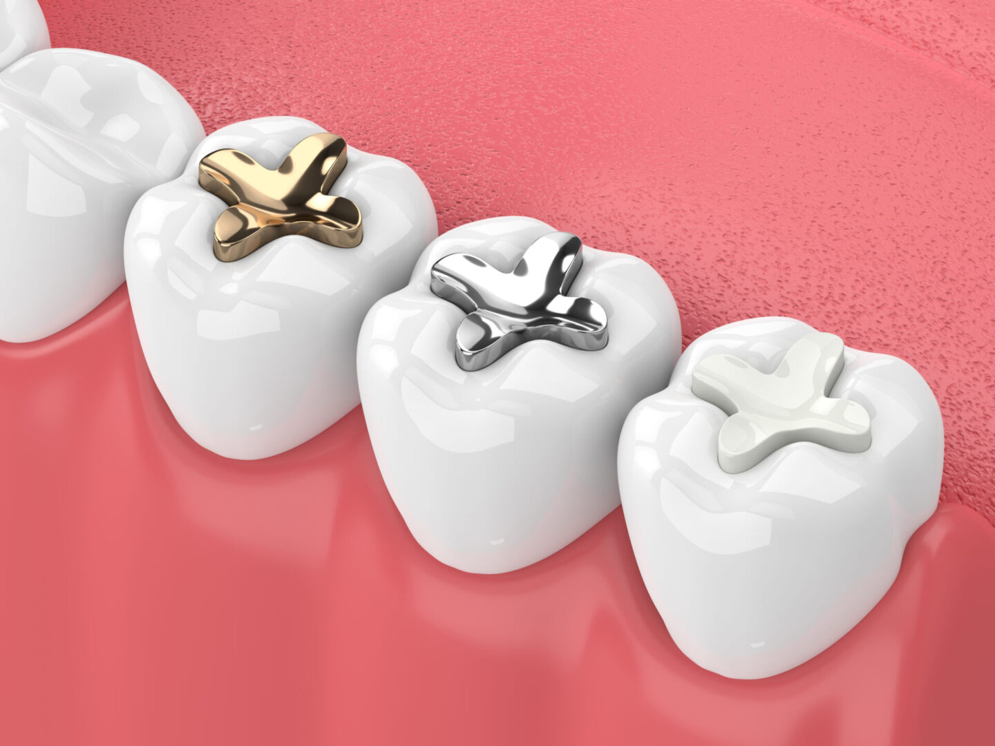 A row of teeth with different colored fillings.